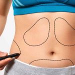 Liposuction