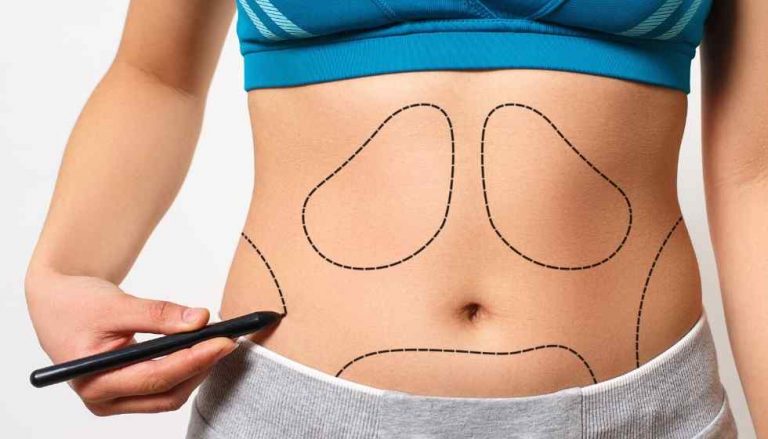 Liposuction