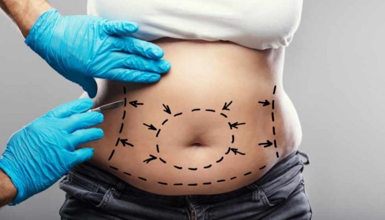 Liposuction